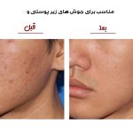 دستگاه میکرودرم خانگی